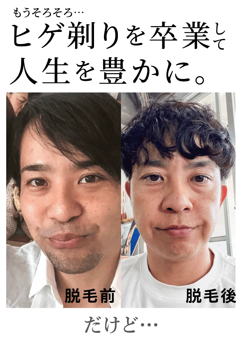 もうそろそろヒゲ剃りを卒業して人生を豊かに。だけど、、、